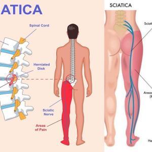 Joint, Sciatica and Nerve Pain Treatment Supplements and Herbal Medicine in Ghana